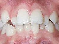 Close-up of crowded front teeth before orthodontic treatment