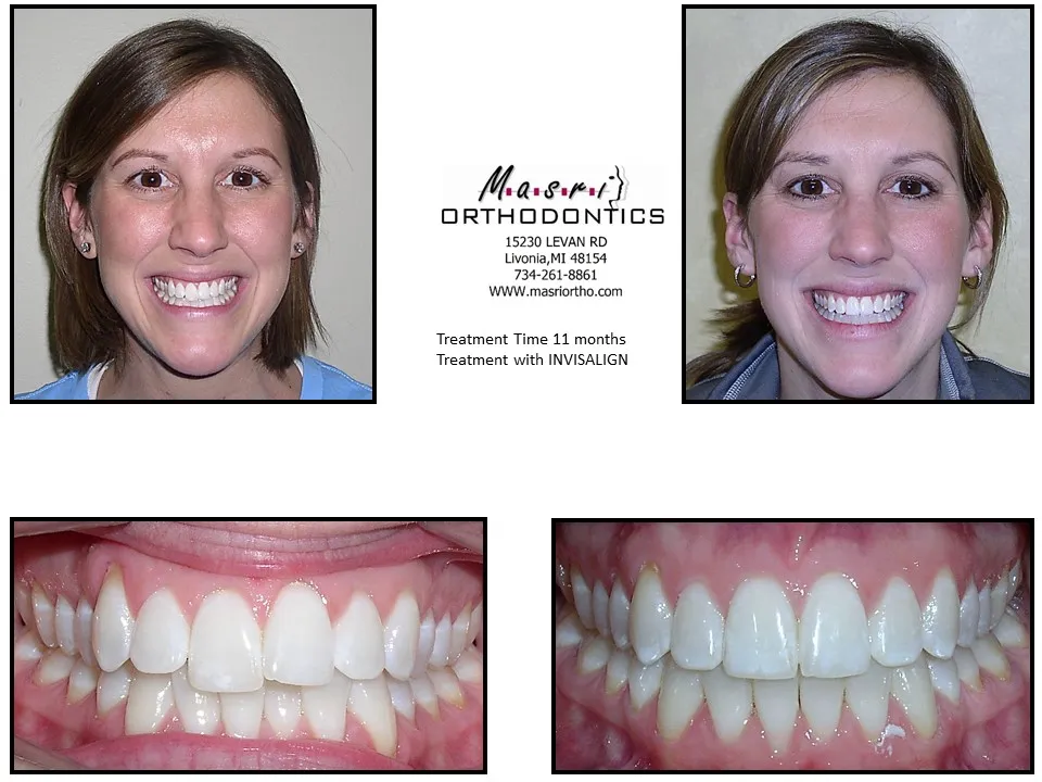 Before and after orthodontic treatment at Masri Orthodontics for a woman with misaligned teeth