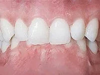Close-up of front teeth with a midline gap