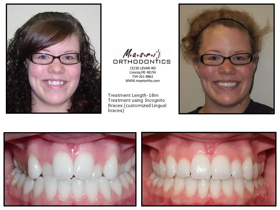 Before and after orthodontic treatment at Masri Orthodontics for a woman with misaligned teeth