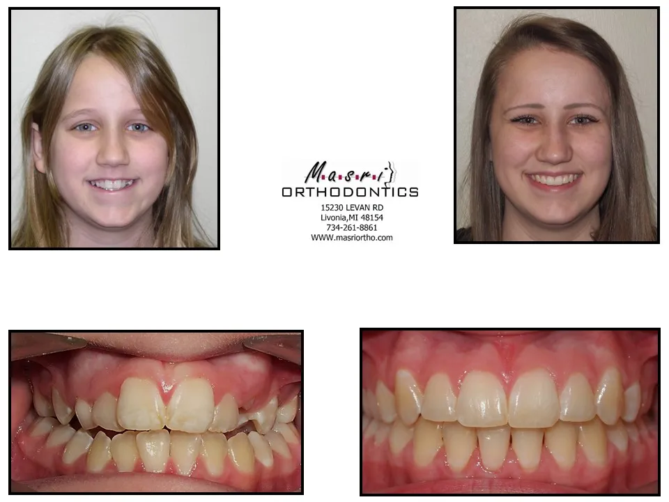 Before and after orthodontic treatment at Masri Orthodontics for a teen girl with crowded teeth
