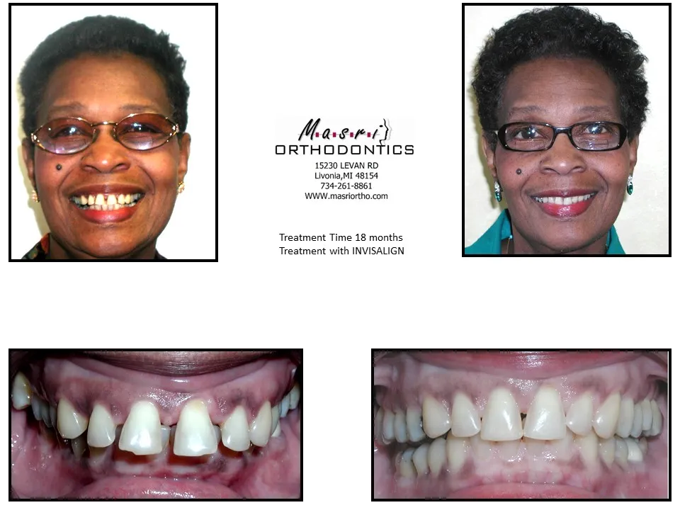Before and after orthodontic treatment at Masri Orthodontics for a woman with crooked front teeth