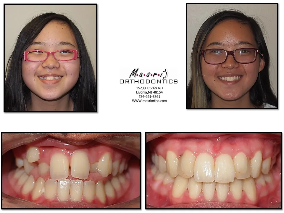 Before and after orthodontic treatment at Masri Orthodontics for a teen girl with misaligned teeth