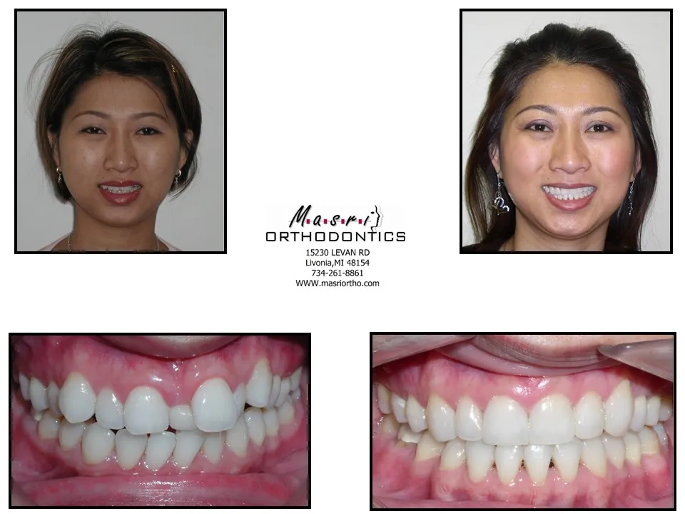 Before and after orthodontic treatment at Masri Orthodontics for a young woman with crowded teeth