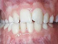 Close-up of crowded front teeth before orthodontic treatment