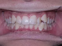 Example front view photo of the teeth for a virtual assessment