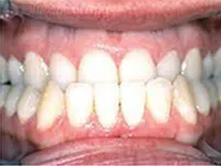 Close-up of crowded lower front teeth