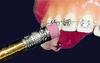 Pencil eraser pushing a poking braces wire back into place