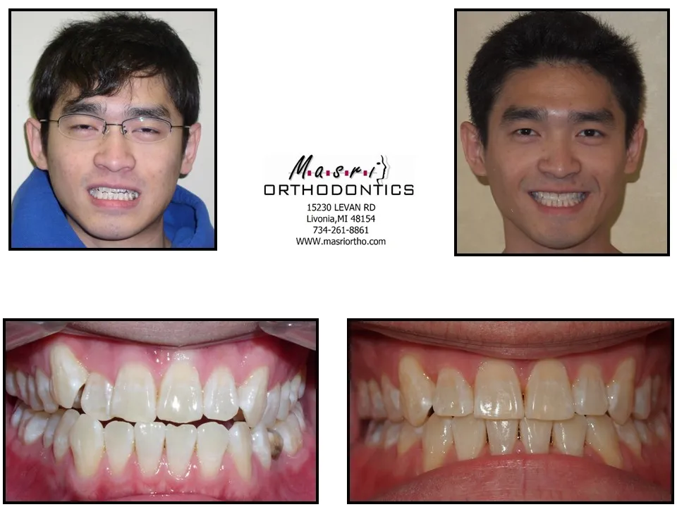 Before and after orthodontic treatment at Masri Orthodontics for a young man with crowded teeth