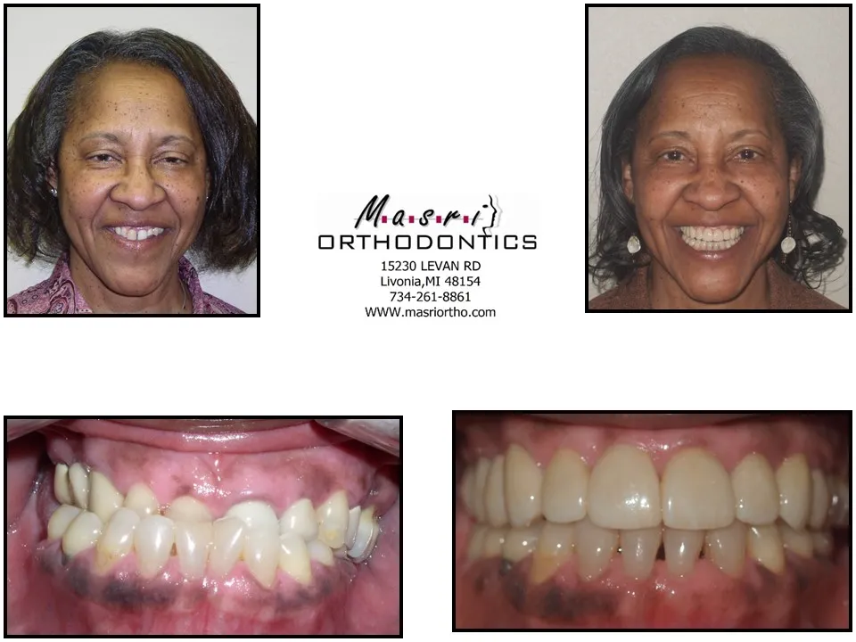 Before and after orthodontic treatment at Masri Orthodontics for a woman with misaligned teeth