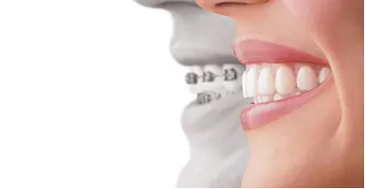 Side view of teeth wearing a clear aligner