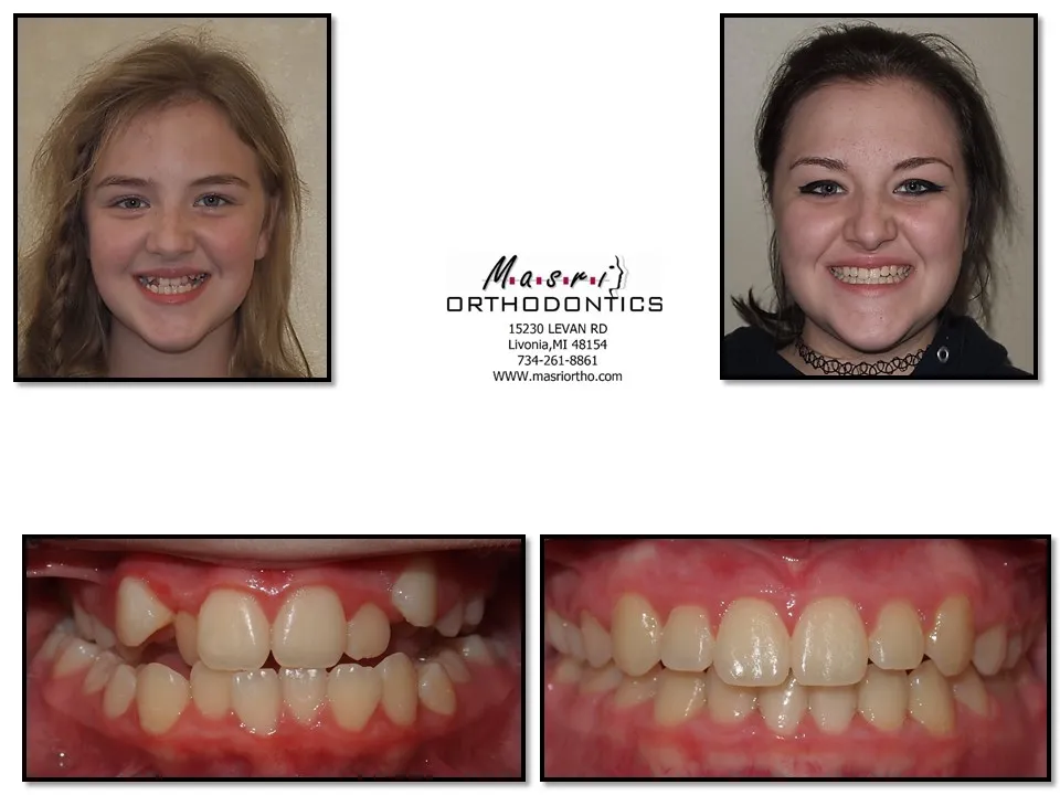 Before and after orthodontic treatment at Masri Orthodontics for a young woman with crowded teeth