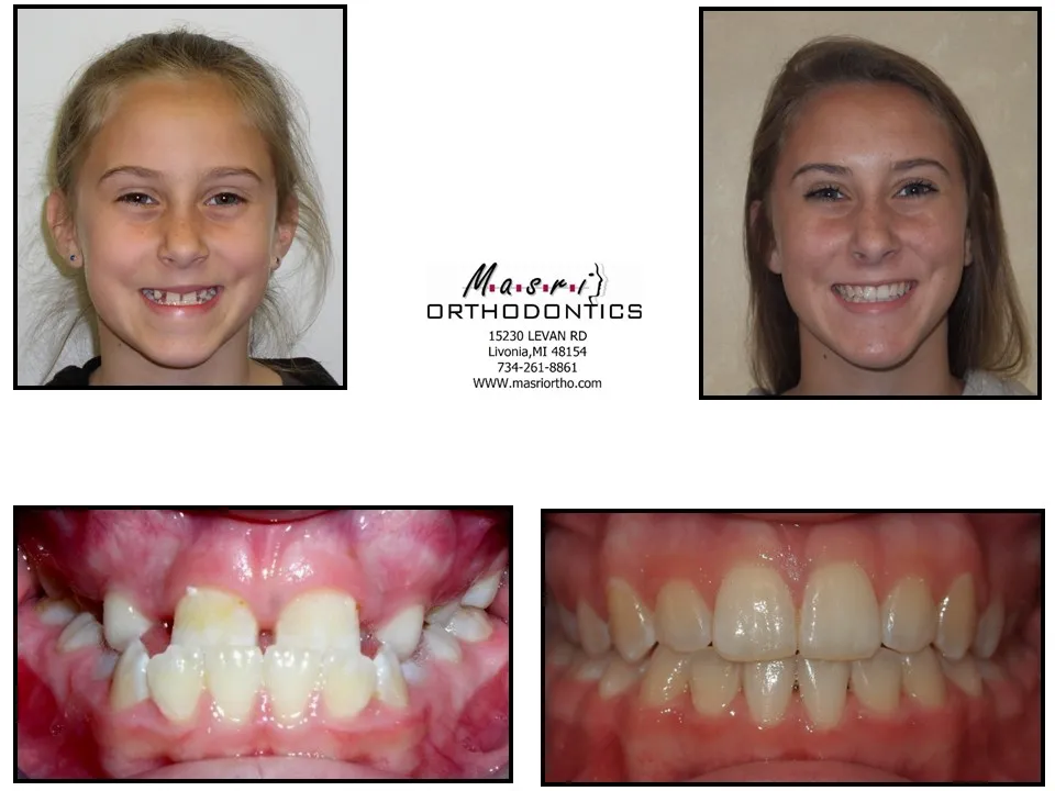 Before and after orthodontic treatment at Masri Orthodontics for a young girl with gaps between the front teeth