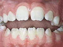 Close-up of an open bite between the front teeth