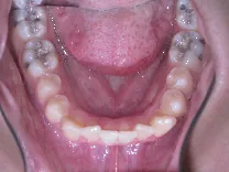 Example photo of the lower teeth taken from above