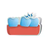 Illustration of a chipped tooth
