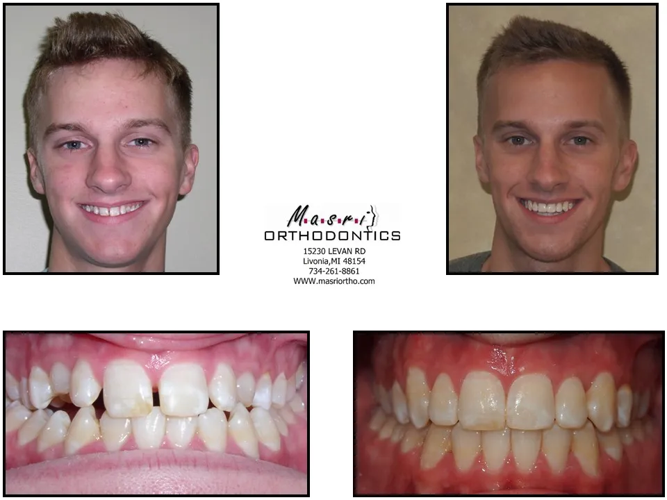 Before and after orthodontic treatment at Masri Orthodontics for a young man with crooked teeth