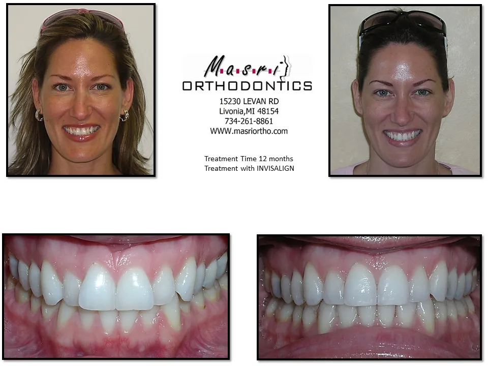 Before and after orthodontic treatment at Masri Orthodontics for a woman with misaligned teeth