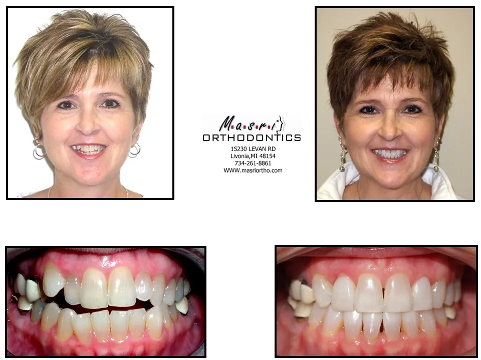 Before and after orthodontic treatment at Masri Orthodontics for a woman with an open bite