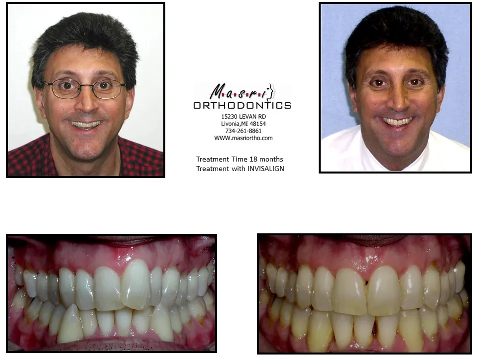 Before and after orthodontic treatment at Masri Orthodontics for a man with misaligned teeth
