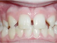Close-up of a large gap between the upper front teeth