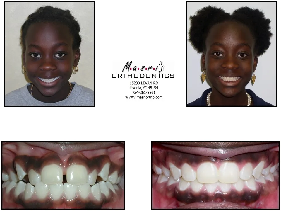 Before and after orthodontic treatment at Masri Orthodontics for a young girl with crowded teeth