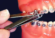 Clippers trimming a loose wire on braces