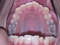 Example photo of the upper teeth taken from below