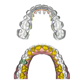 Digital design of Incognito lingual braces on the upper and lower arches