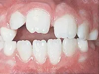 Close-up of misaligned front teeth with a gap