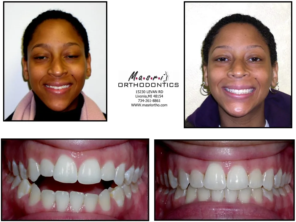 Before and after orthodontic treatment at Masri Orthodontics for a young woman with an open bite