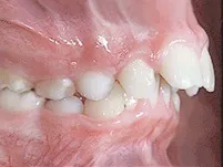Close-up of crooked teeth before orthodontic treatment