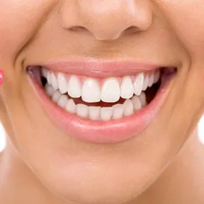 Close-up of a bright smile with braces hidden behind the teeth