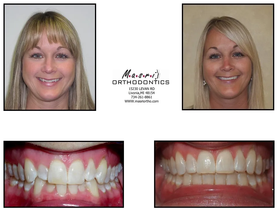 Before and after orthodontic treatment at Masri Orthodontics for a woman with misaligned teeth