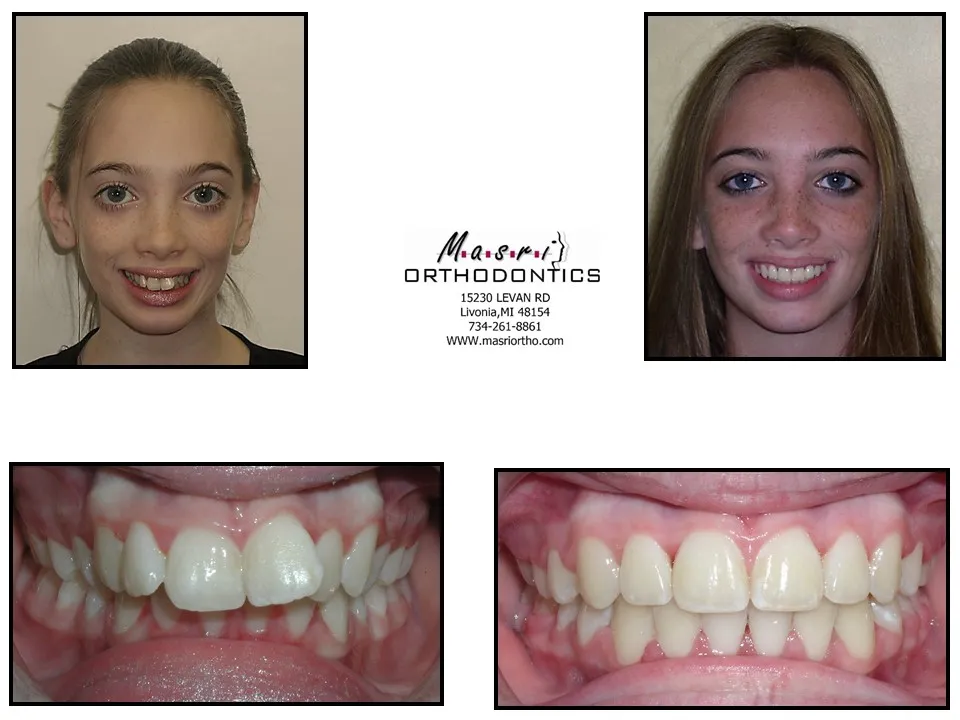 Before and after orthodontic treatment at Masri Orthodontics for a teen girl with crowded teeth