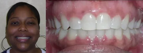 Woman's portrait next to a close-up of her smile after orthodontic treatment