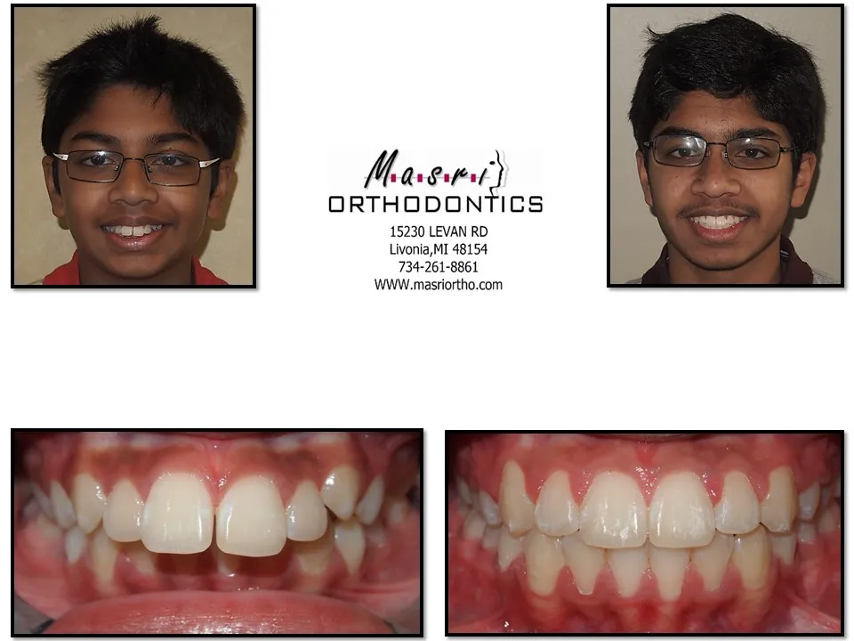 Before and after orthodontic treatment at Masri Orthodontics for a teen boy with misaligned teeth