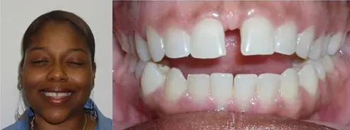 Woman's portrait next to a close-up of a gap between her front teeth before treatment