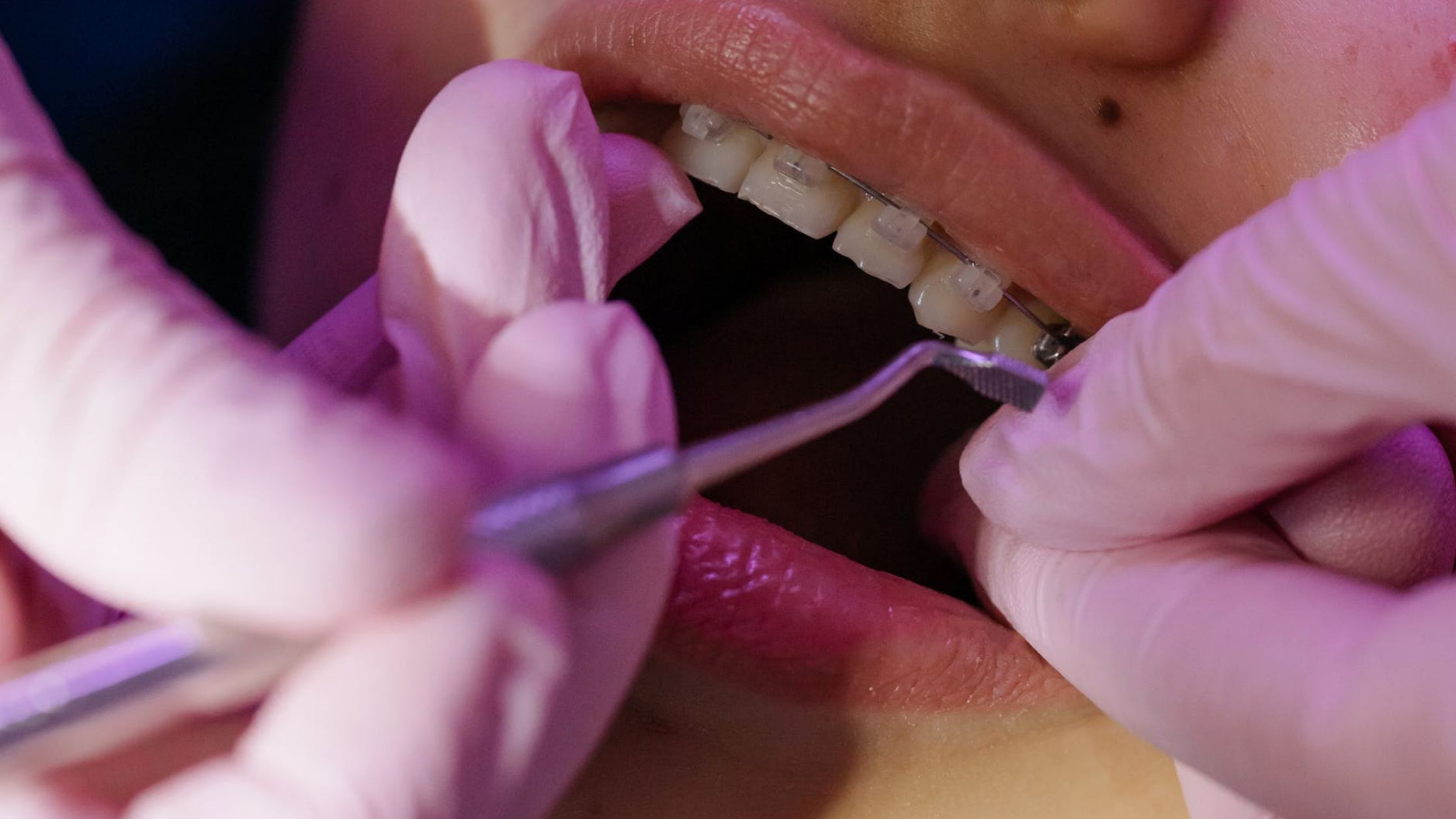 Gloved hands examining teeth with a dental instrument