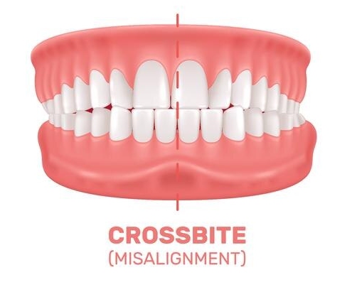 Illustration of a crossbite on a dental model