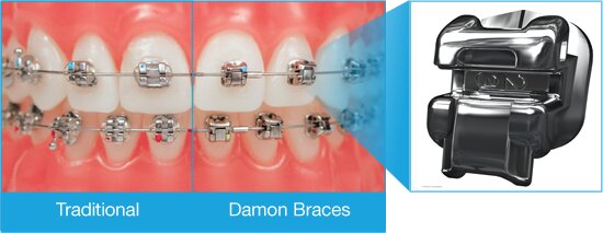 Illustration comparing traditional braces and Damon self-ligating braces
