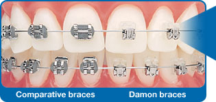 Illustration comparing conventional braces and Damon self-ligating braces