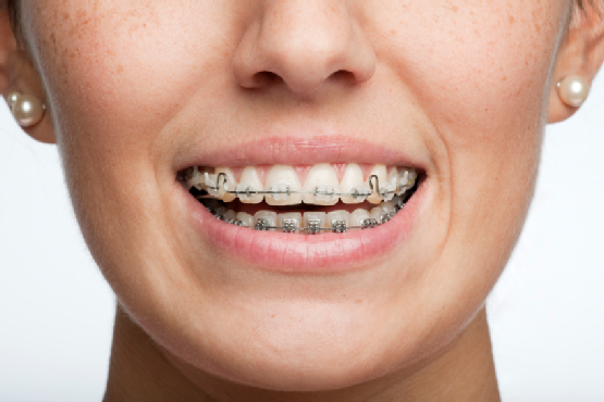 Close-up of a smile with metal braces