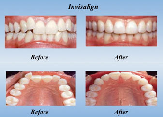 Invisalign before and after photos of the upper and lower teeth