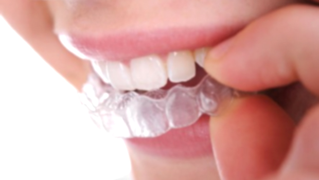 Hand placing a clear aligner on the upper teeth