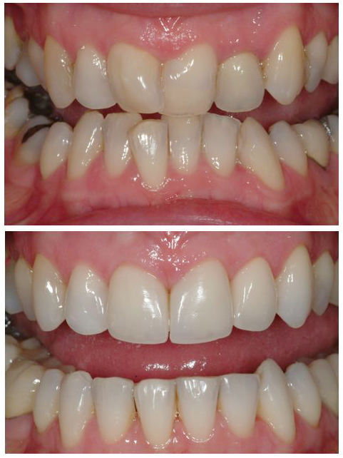Before and after photos of crowded teeth straightened