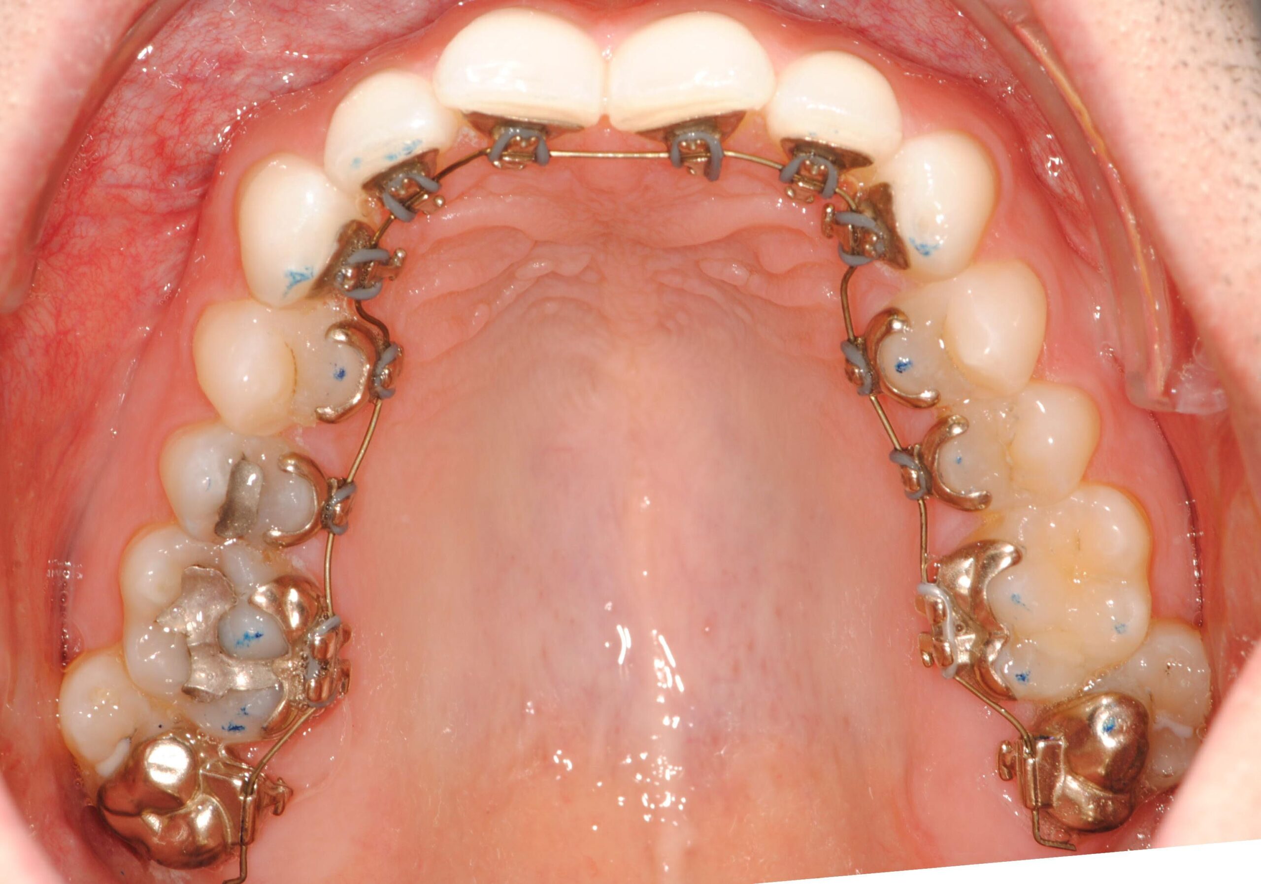 Incognito hidden braces bonded to the back of the upper teeth