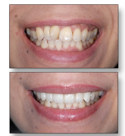 Before and after photos of a smile with crooked front teeth straightened