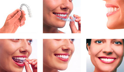 Collage of smiling people and a hand holding a clear aligner