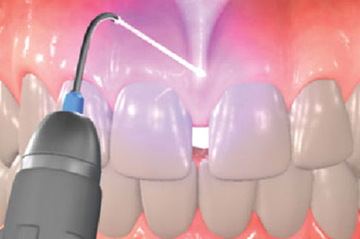 Dental laser device aimed at the front teeth